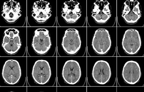 Anti-oxidants in the brain and Alzheimer’s